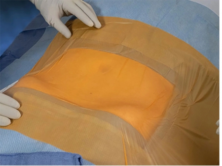 Inzisionsfolie mit Jod