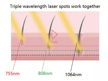 755nm&808nm&1064nm Laser-Enthaarung für 6 Fitzpatrick Hauttypen, FG2000-B